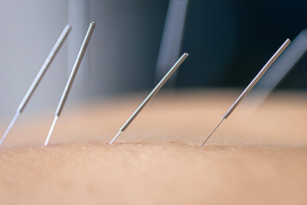 Acupuncture  Palmetto, FL